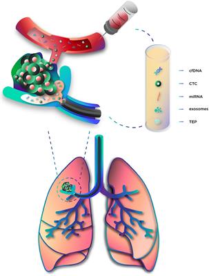 The Role of Liquid Biopsy in Early Diagnosis of Lung Cancer